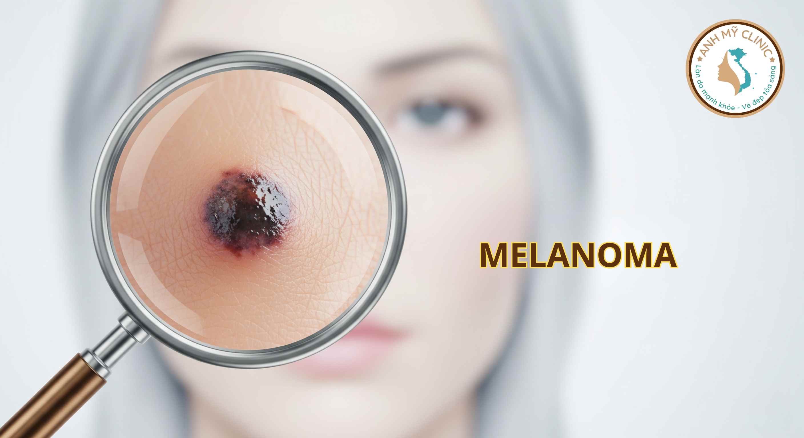 Ung Thư Melanoma: Nhận Diện Nốt Ruồi Nguy Hiểm & Điều Trị
