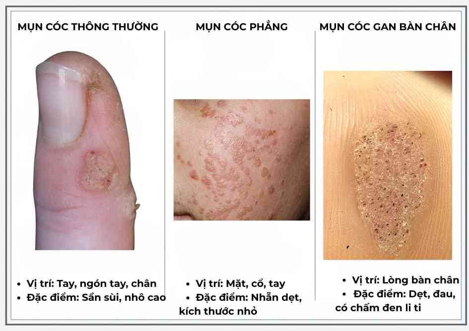phan-biet-cac-loai-mun-coc.jpg So sánh hình ảnh mụn cóc thông thường, mụn cóc phẳng, mụn cóc bàn chân