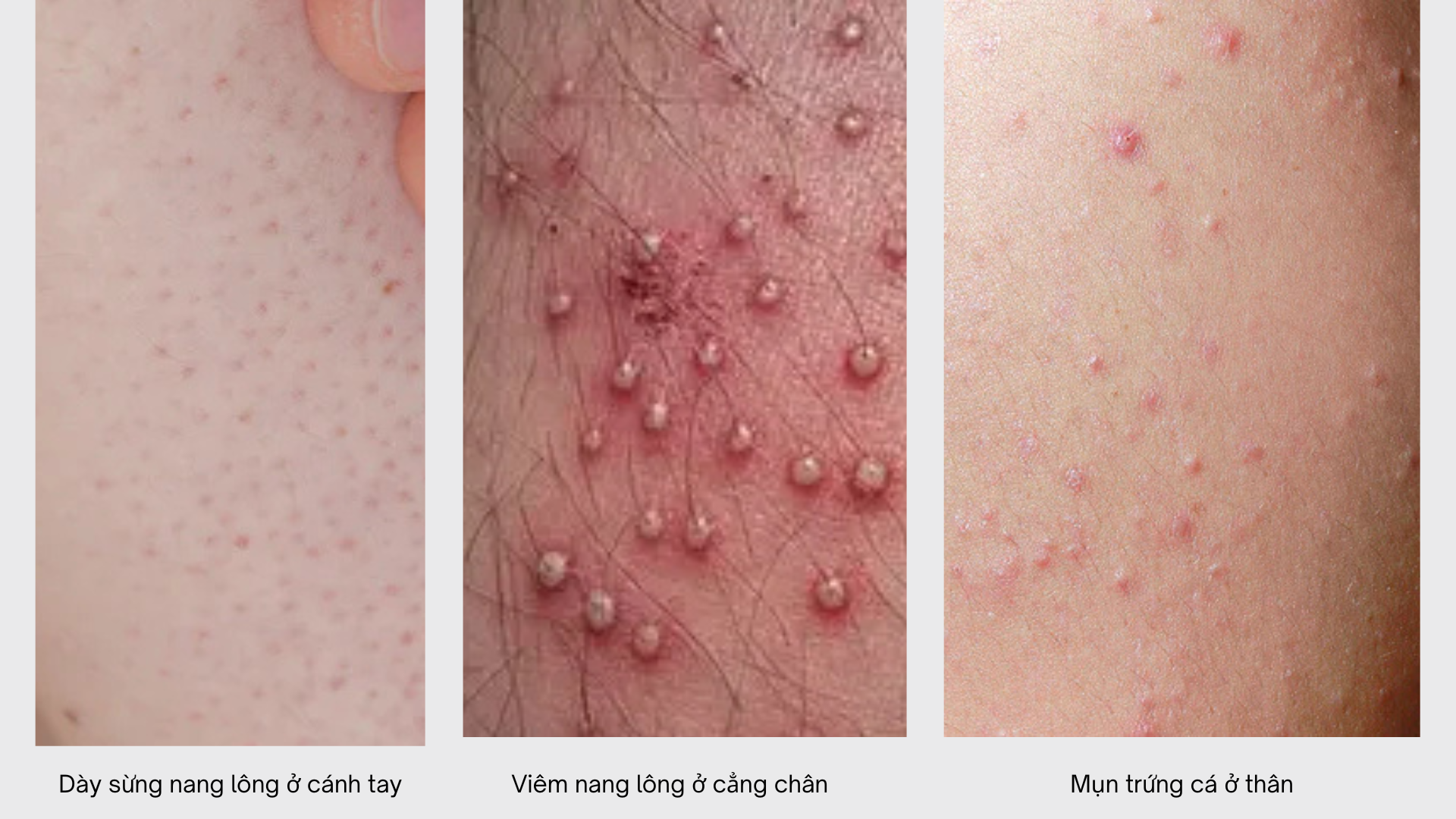 Ph&acirc;n biệt: d&agrave;y sừng nang l&ocirc;ng, vi&ecirc;m nang l&ocirc;ng, mụn trứng c&aacute; th&acirc;n