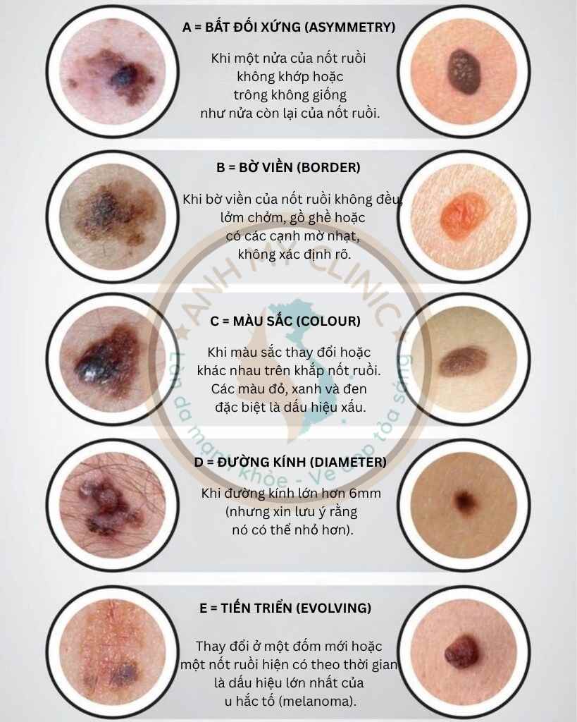 Ph&acirc;n biệt u l&agrave;nh da v&agrave; u &aacute;c t&iacute;nh