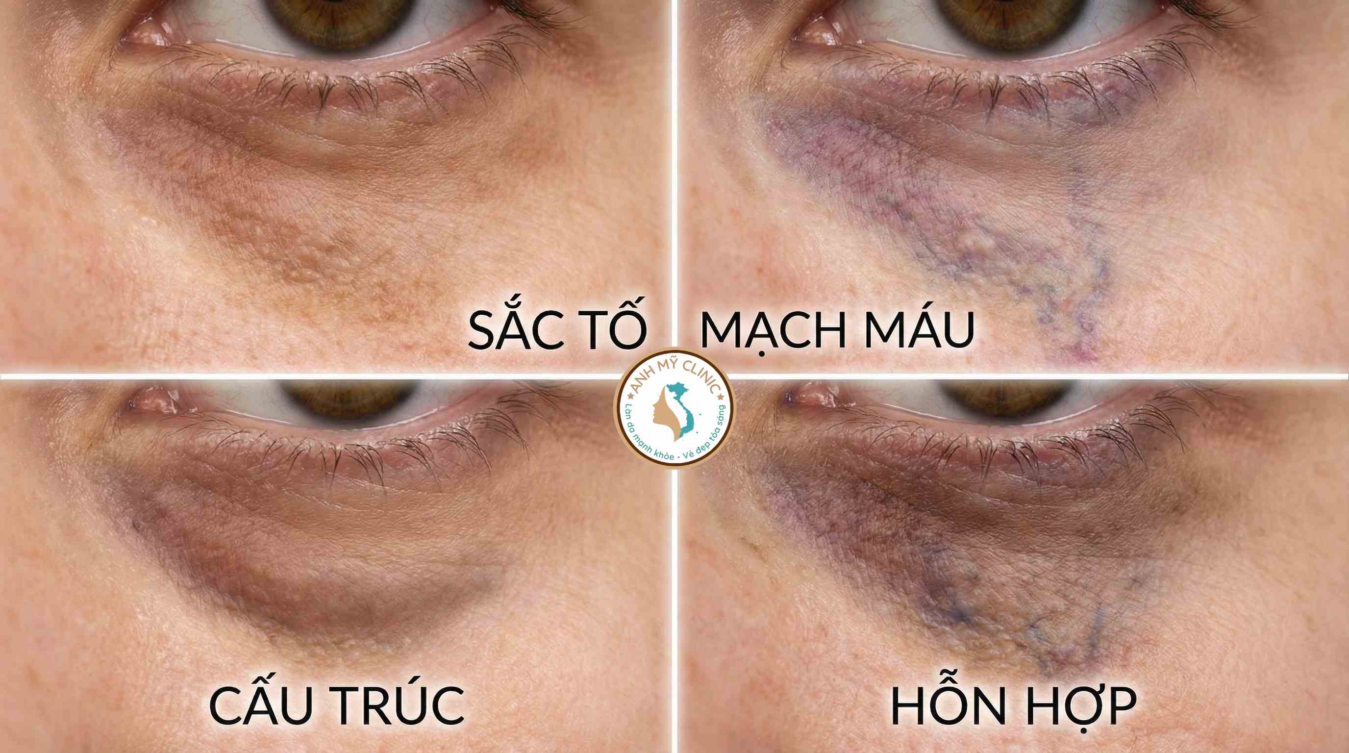 phan-loai-4-loai-quang-tham-mat.jpg Hình ảnh minh họa y khoa phân biệt 4 loại quầng thâm mắt: sắc tố, mạch máu, cấu trúc và hỗn hợp.