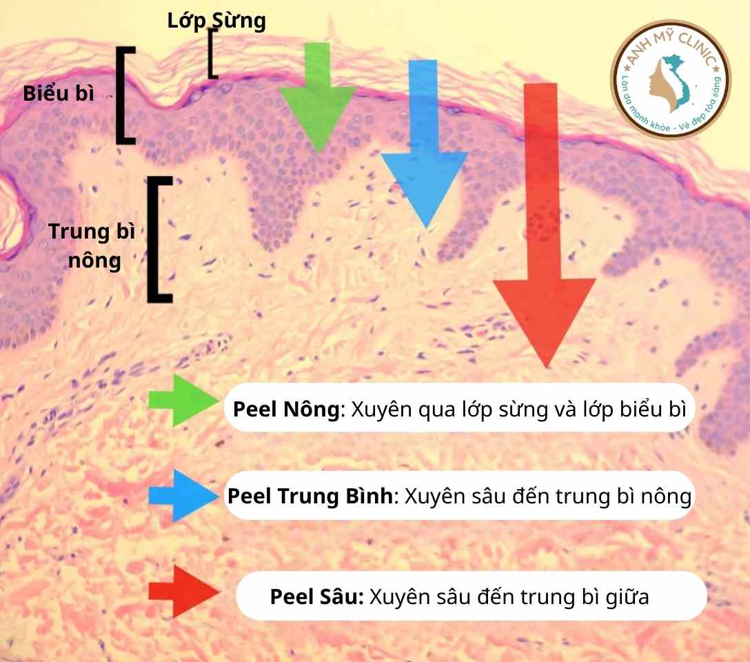 phan-loai-cap-do-peel-da-2.jpg Phân biệt 3 cấp độ peel da hóa học và ứng dụng tương ứng.