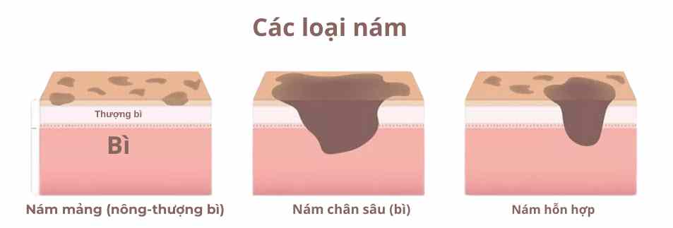 phan-loai-nam-anh-my-clinic.jpg Phân loại nám