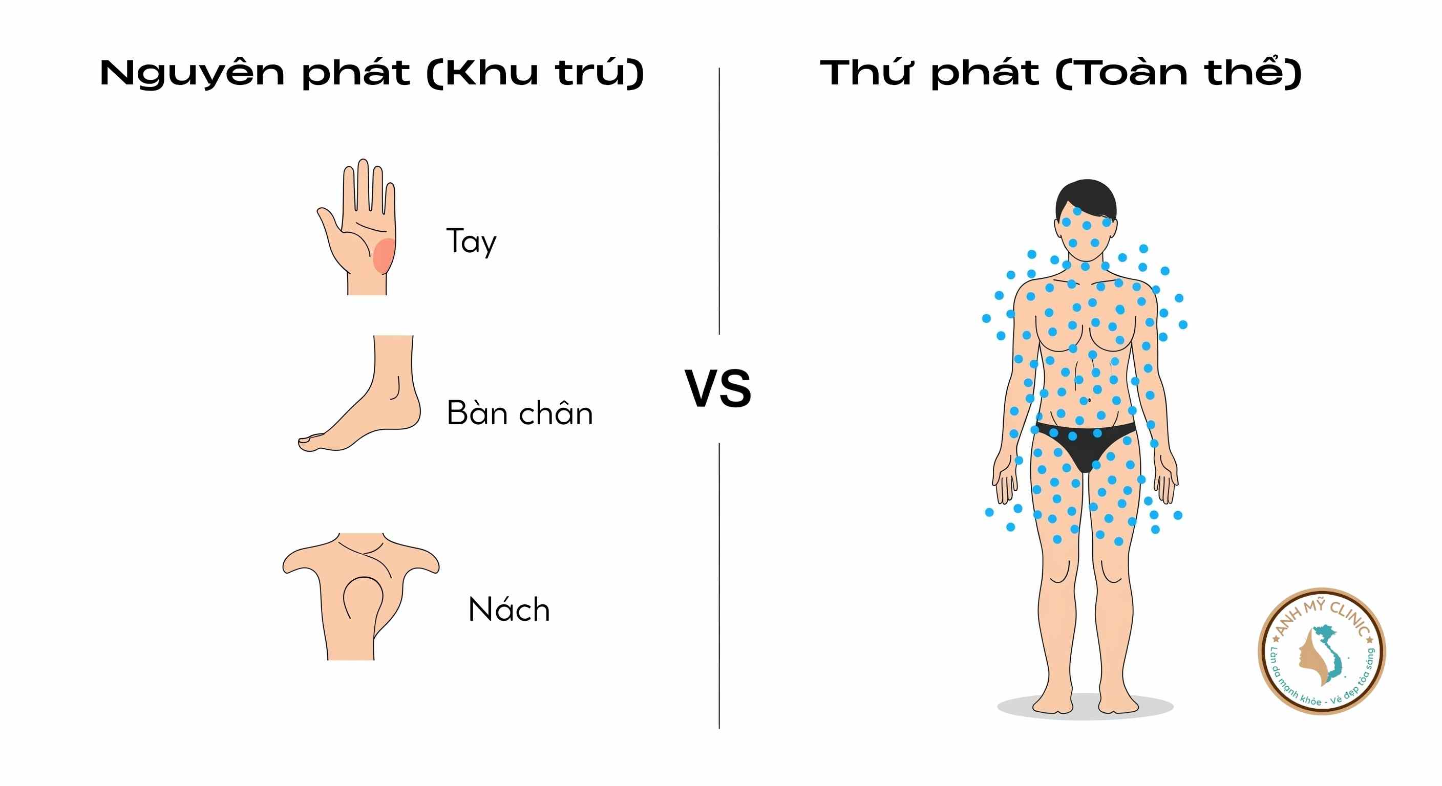 Ph&acirc;n loại tăng tiết mồ h&ocirc;i