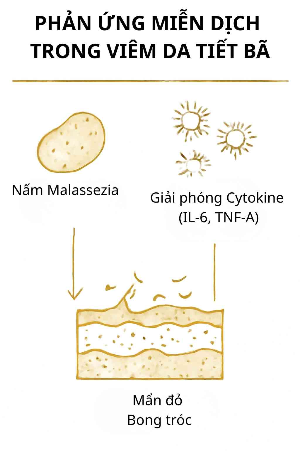 phan-ung-mien-dich-trong-viem-da-tiet-ba.jpg Sơ đồ phản ứng miễn dịch trong viêm da tiết bã: nấm Malassezia kích hoạt tế bào viêm.