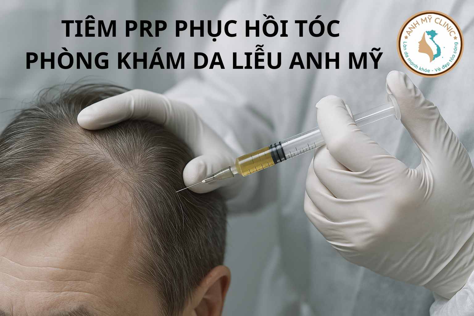 prp-dieu-tri-rung-toc-anh-my-clinic-jpg.jpeg Liệu pháp tiêm PRP kích thích mọc tóc tại Phòng Khám Da Liễu Anh Mỹ do Bs Trương Lê Đạo thực hiện