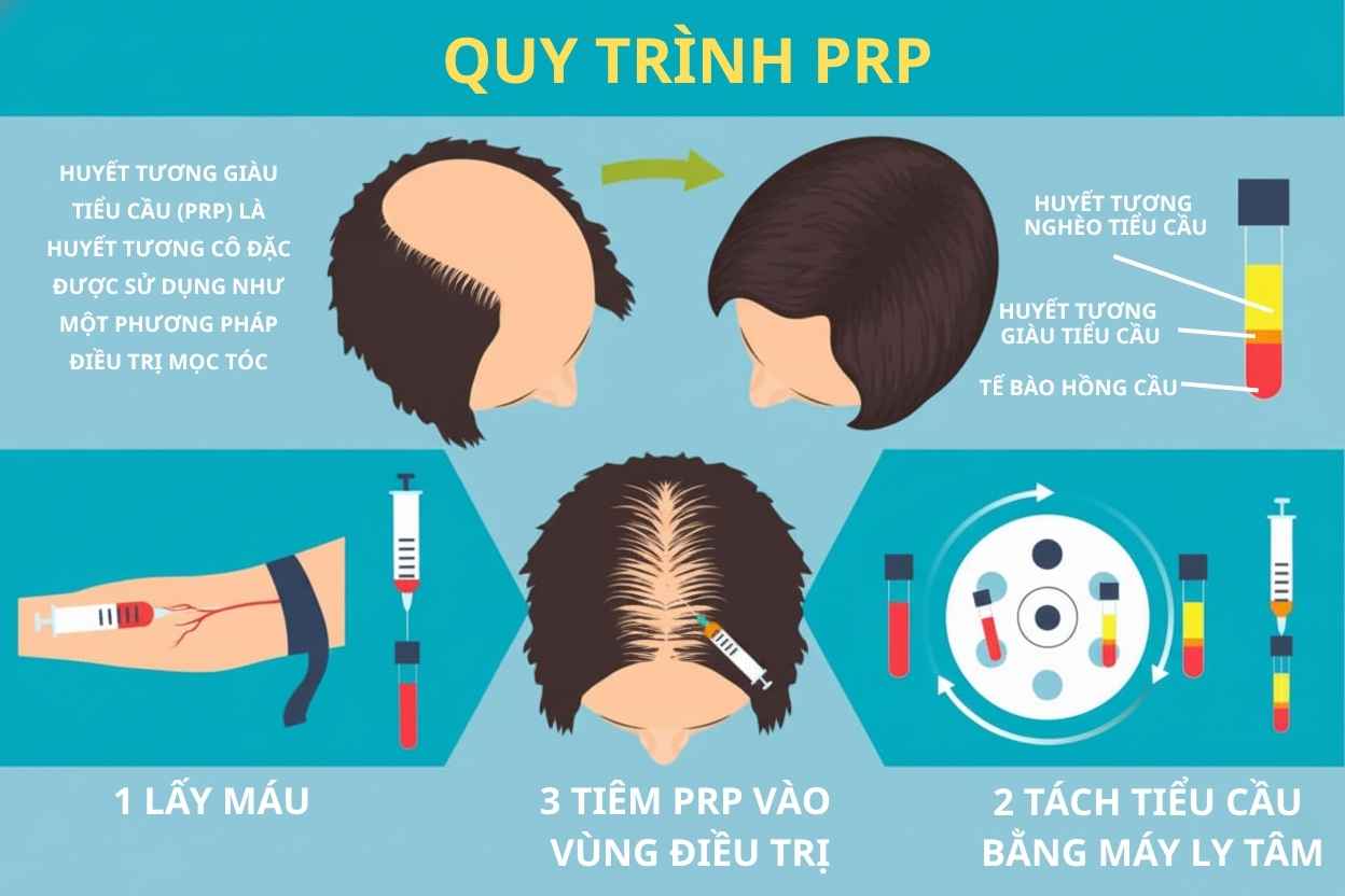 qui-trinh-prp-jpg.jpeg Qui trình PRP