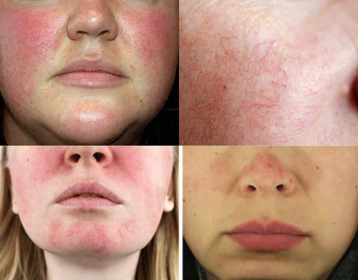 Doxycycline Có Hiệu Quả Trong Điều Trị Trứng Cá Đỏ? Tìm Hiểu Ngay!