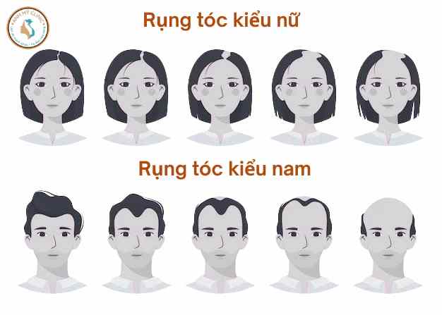 Rụng t&oacute;c androgen