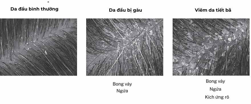 Ba h&igrave;nh ảnh vi m&ocirc; so s&aacute;nh da đầu b&igrave;nh thường, da đầu bị g&agrave;u v&agrave; da đầu vi&ecirc;m da tiết b&atilde;, thể hiện mức độ bong vảy, ngứa v&agrave; k&iacute;ch ứng kh&aacute;c nhau.