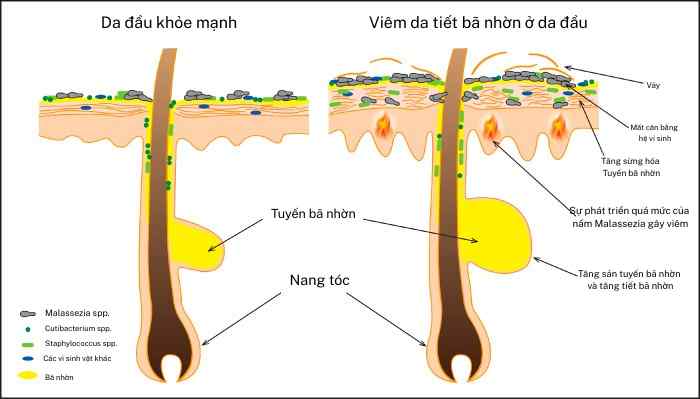 Sơ đồ cắt ngang da đầu so s&aacute;nh giữa da đầu khỏe mạnh v&agrave; da đầu bị vi&ecirc;m da tiết b&atilde; nhờn, thể hiện tuyến b&atilde; ph&igrave; đại, tăng tiết b&atilde;, d&agrave;y sừng v&agrave; sự ph&aacute;t triển qu&aacute; mức của nấm Malassezia.