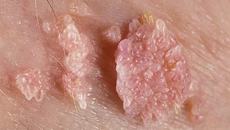 Sùi mào gà và cách đào thải HPV hiệu quả theo chuyên gia TP.HCM
