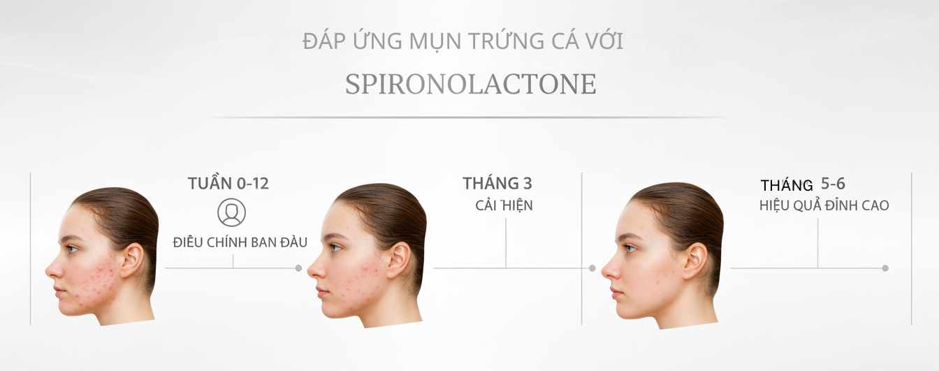 Infographic m&ocirc; tả timeline hiệu quả spironolactone trong mụn tuổi dậy th&igrave; nữ: 8&ndash;12 tuần bắt đầu đ&aacute;p ứng, 5&ndash;6 th&aacute;ng tối đa.