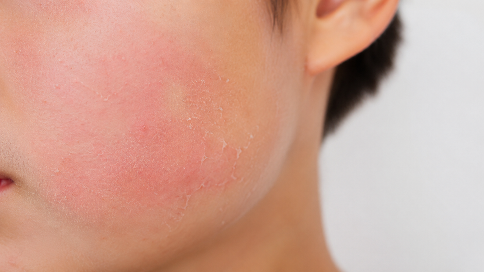  Da thiếu ni&ecirc;n bị k&iacute;ch ứng nhẹ do d&ugrave;ng retinol &mdash; đỏ da v&agrave; bong tr&oacute;c l&agrave; t&aacute;c hại thường gặp