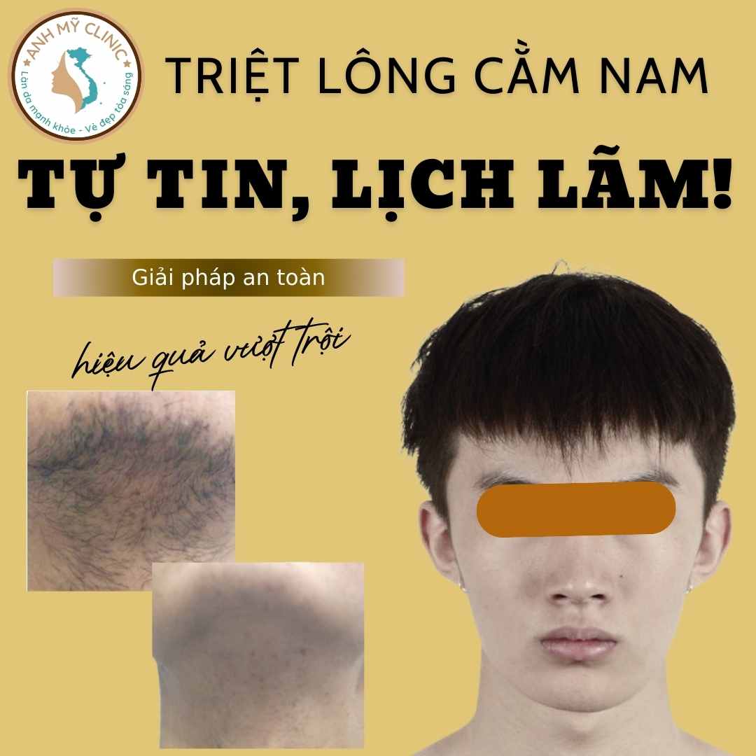 Triệt lông cằm nam