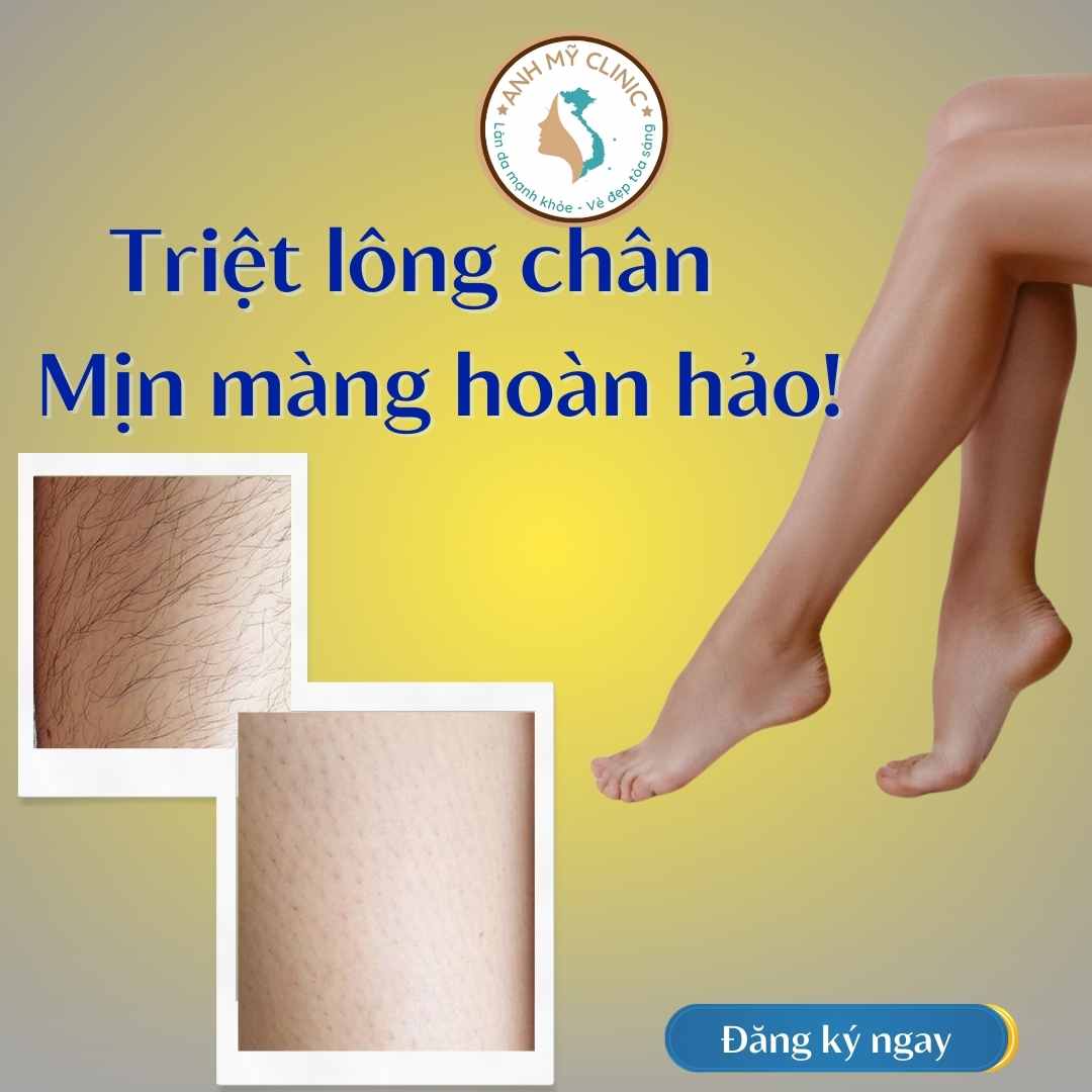 Triệt lông chân