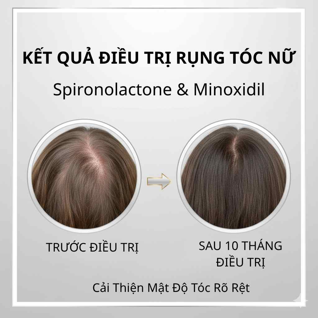 Cải thiện mật độ t&oacute;c sau 10 th&aacute;ng điều trị rụng t&oacute;c kiểu nữ bằng spironolactone tại Anh Mỹ Clinic.
