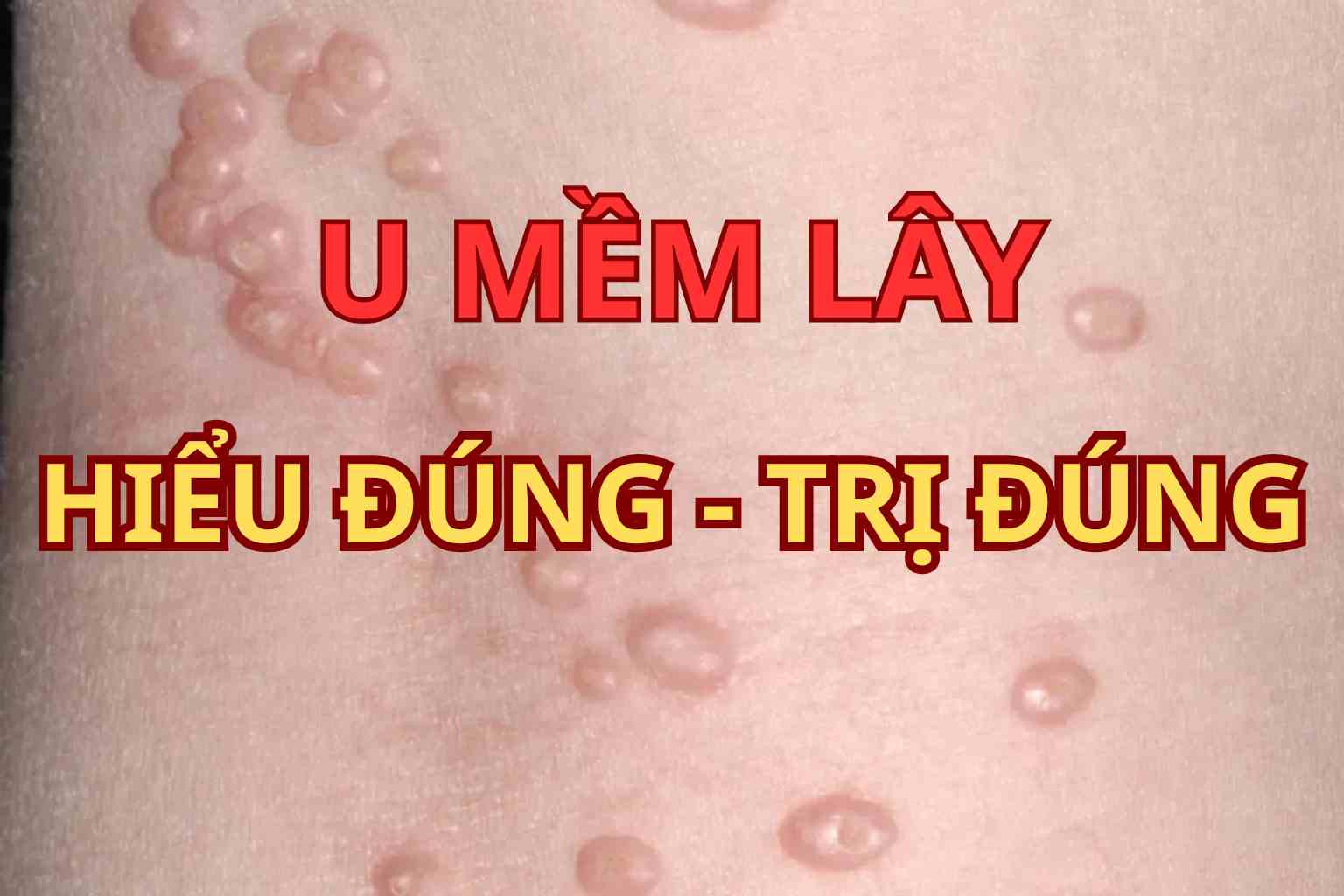U mềm lây: định nghĩa, điều trị & thời gian khỏi