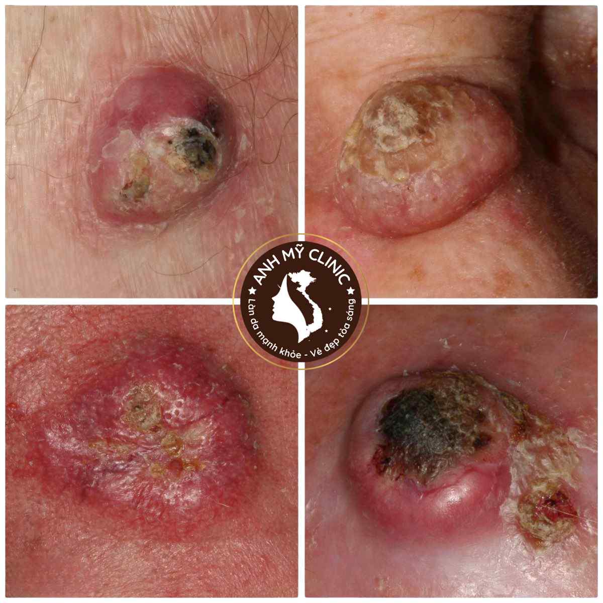 Ung thư biểu m&ocirc; tế b&agrave;o vảy