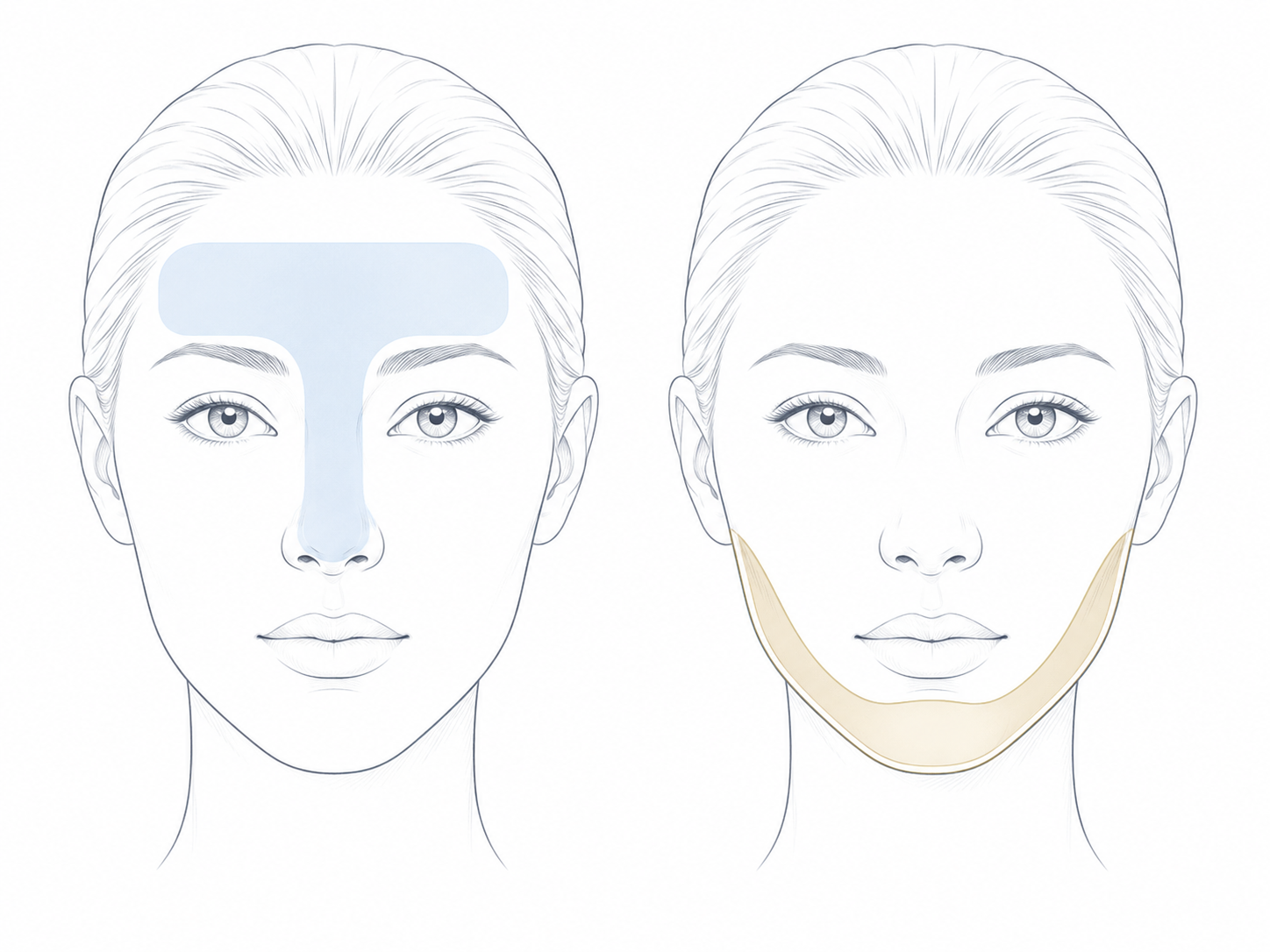 So s&aacute;nh vị tr&iacute; tổn thương mụn tuổi teen (v&ugrave;ng T) v&agrave; mụn người lớn (cằm, jaw line)