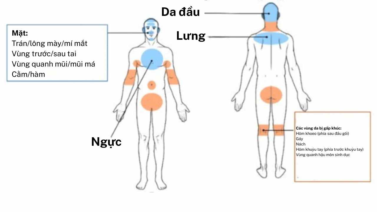 Sơ đồ cơ thể người nh&igrave;n từ trước v&agrave; sau, t&ocirc; m&agrave;u v&ugrave;ng thường bị vi&ecirc;m da tiết b&atilde; gồm da đầu, mặt, ngực, lưng v&agrave; c&aacute;c v&ugrave;ng da gấp kh&uacute;c như g&aacute;y, n&aacute;ch, khuỷu tay, khoeo ch&acirc;n, quanh hậu m&ocirc;n &ndash; sinh dục.