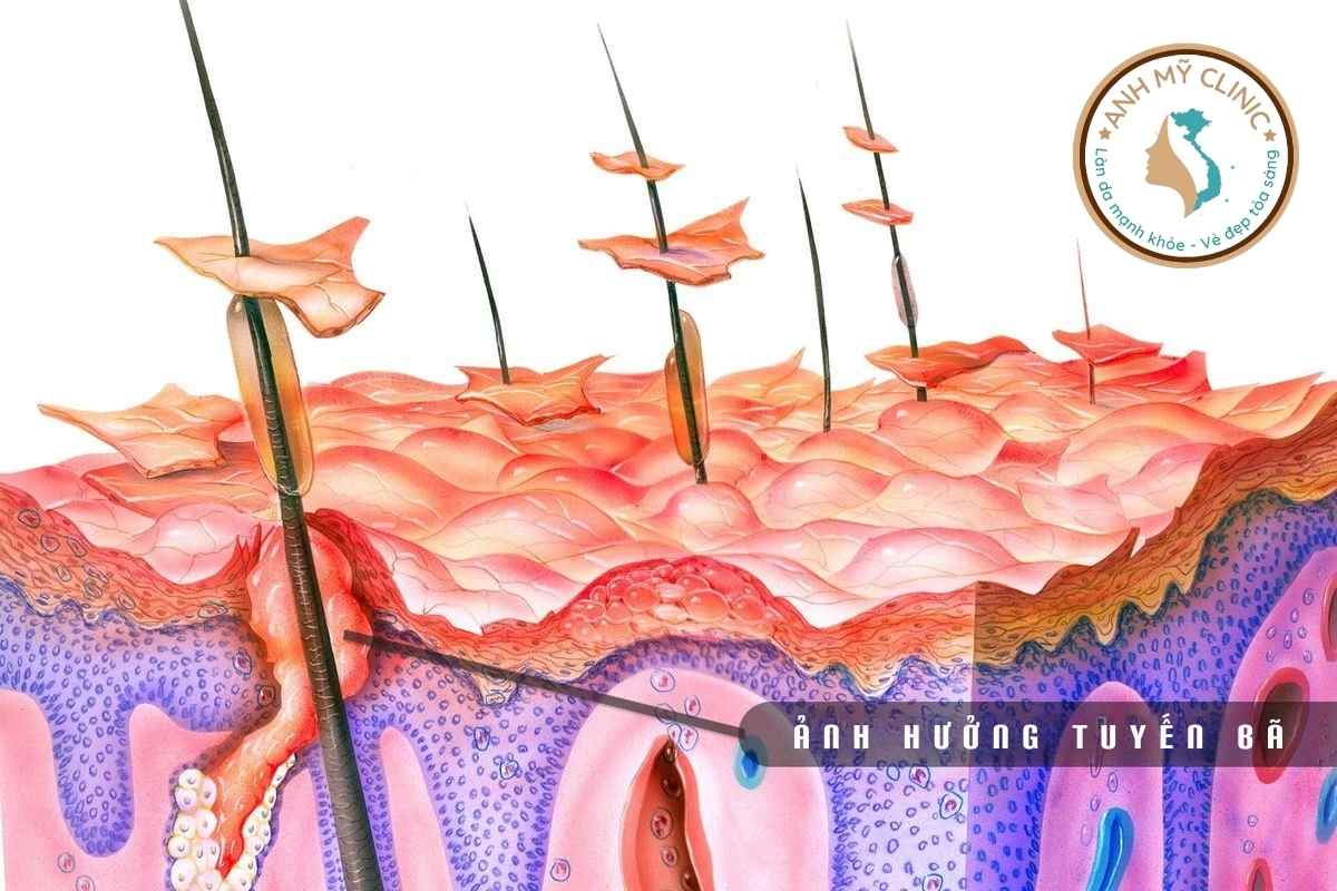 viem-da-dau.jpg Viêm da dầu ảnh hưởng tuyến bã