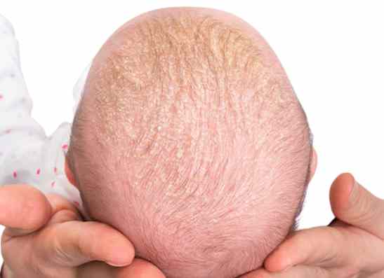 viem-da-tiet-ba-o-tre-so-sinh-cut-trau.jpg Hình ảnh viêm da tiết bã ở trẻ sơ sinh với vảy vàng nhẹ trên da đầu (cứt trâu).