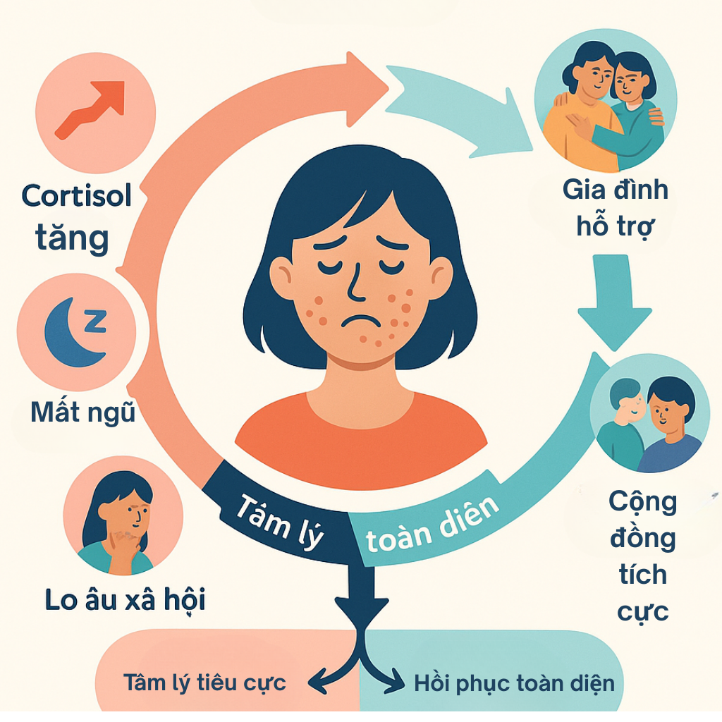 Vòng xoắn stress-mụn-tâm lý