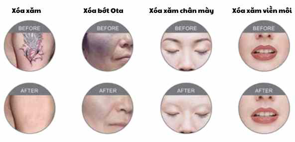 xoa-xam-bot-ota-chan-may-moi.png Xóa xăm, bớt Ota, xăm chân mày, xăm môi