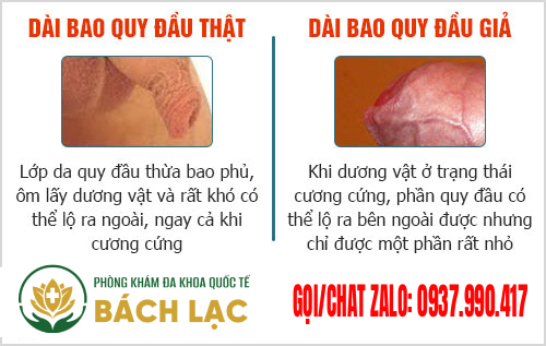 Bao Quy Đầu Dài Có Ảnh Hưởng Gì Không? Địa Chỉ Cắt Dài Bao Quy Đầu