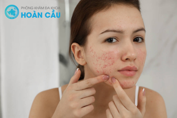 Gợi ý địa chỉ chữa mụn trứng cá nặng TPHCM nhiều người đánh giá cao