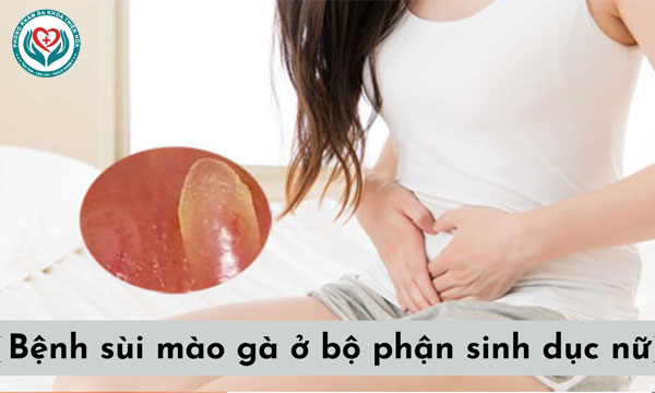 Tìm hiểu về sùi mào gà ở nữ và cách điều trị hiệu quả