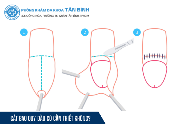 Cắt bao quy đầu có thực sự cần thiết không?