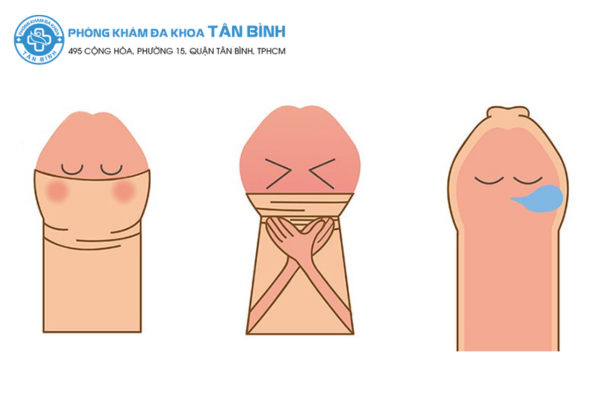 Cắt bao quy đầu là gì? Khi nào nên thực hiện?