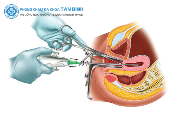 Phương pháp phá thai bệnh viện hùng vương