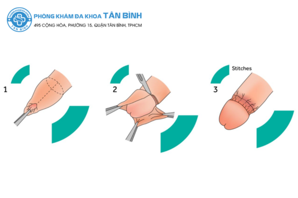 qui-trinh-cat-bao-quy-dau