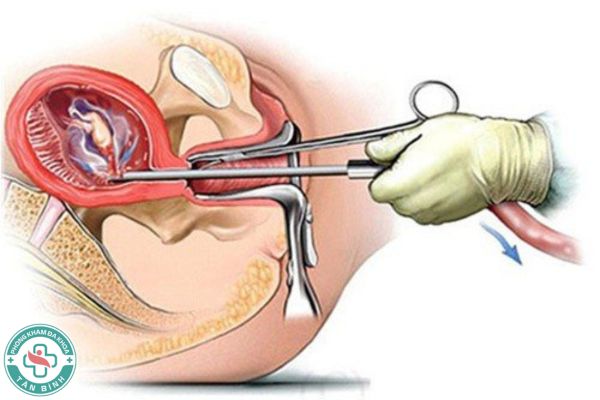 Đình Chỉ Thai Kỳ An Toàn Tại Nhà Có Được Không? Lưu Ý Khi Thực Hiện