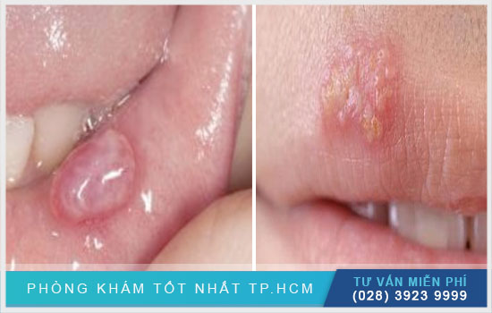 Miệng Bị Nổi Mụn Nước Có Nguy Hiểm Không? Cách Điều Trị Hiệu Quả
