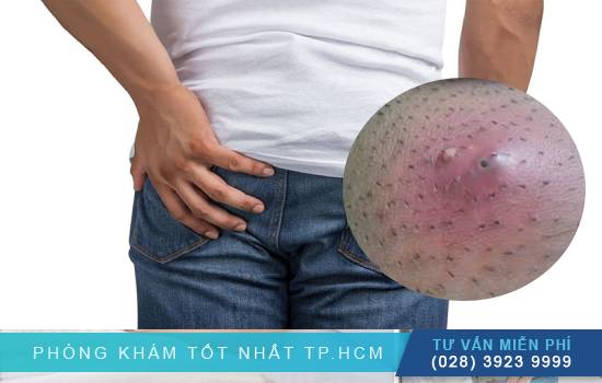 Các Phương Pháp Xét Nghiệm Chẩn Đoán Áp Xe Quanh Hậu Môn