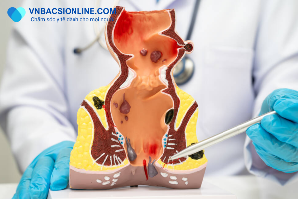 Tâm lý e dè khiến nhiều người chậm trễ trong việc khám trĩ