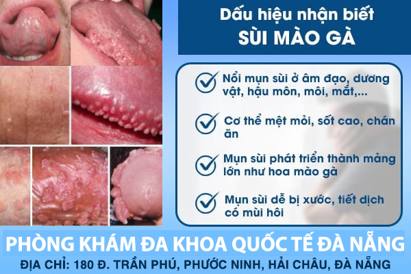 Dấu hiệu của sùi mào gà