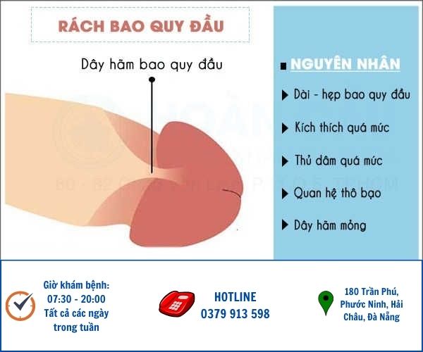 Nguyên nhân gây rách bao quy đầu