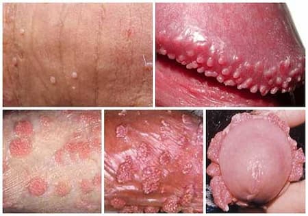 Hình ảnh bệnh sùi mào gà giai đoạn đầu ở nam giới và phụ nữ